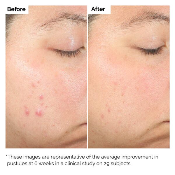 SALICYLIC ACID 2% SOLUTION 30 ML SERUM FOR ACNE - Image 2